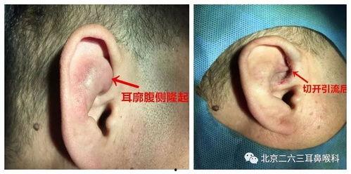 耳廓假性囊肿手术视频,耳廓假性囊肿手术过程详解