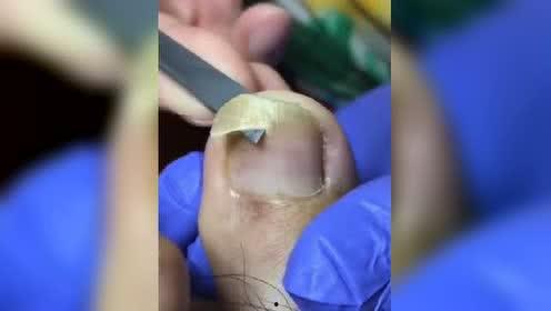 修理嵌甲的视频,跟随视频学习专业修理技巧