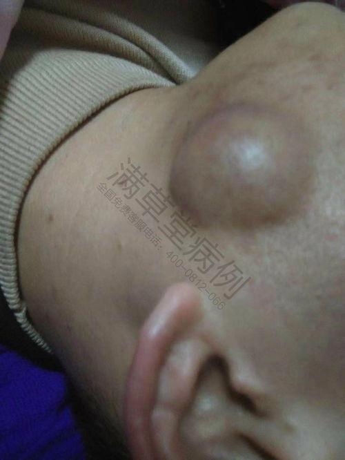 粉瘤手术视频,专业医生带你了解手术细节